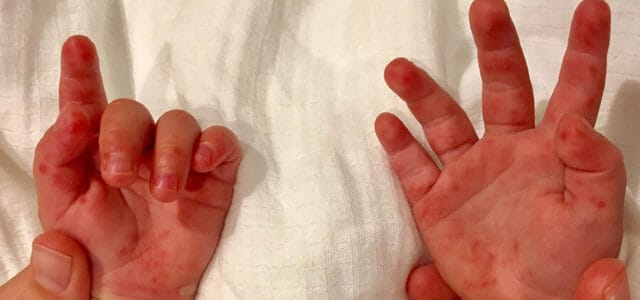 Enfermedad boca mano pie síntomas
