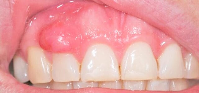 Épulis dental