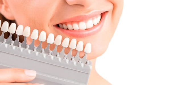 Tonos de carillas dentales