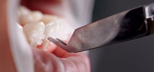 Discreción gracias a los brackets estéticos de cerámica Elige los brackets estéticos de cerámica en la Clínica Dental Ferrus & Bratos