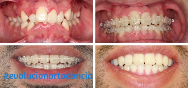 evolucion ortodoncia proceso de ortodoncia brackets