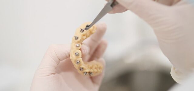 Opiniones sobre brackets Experiencia brackets