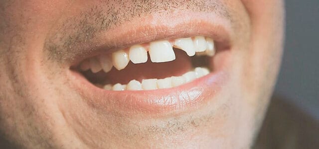 Fractura de un diente
