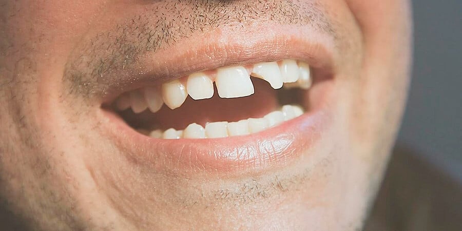 la pérdida de peso puede causar dentaduras sueltas