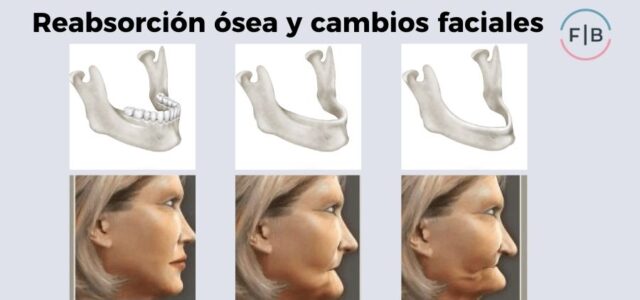 la falta de muelas deforma la cara