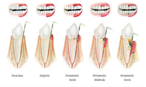 periodontitis-gingivitis-fases