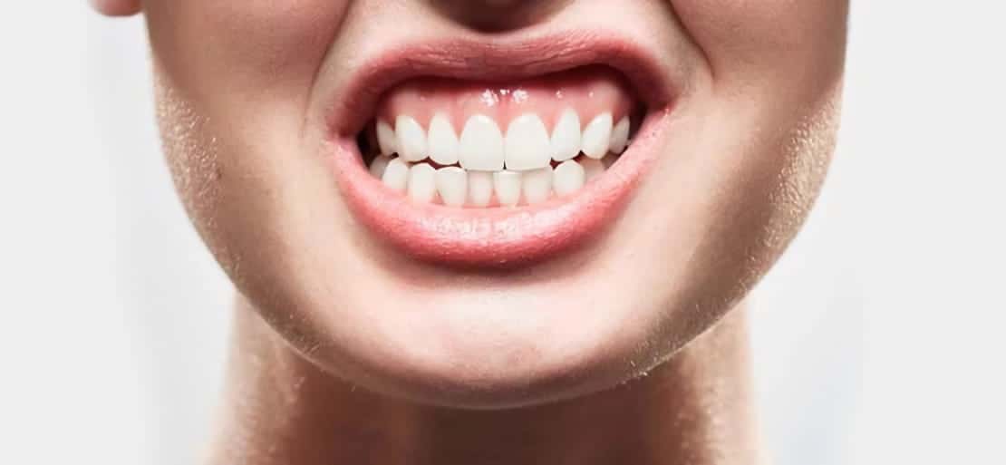 Férula Dental: Qué es, tipos y precio