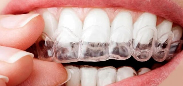 Runesol Ferula Descarga Bruxismo, 4 x Normal, Férulas Dental Moldeable,  Protector Bucal para Dormir, Ferulas de Descarga para Bruxismo, Ferula  Dental