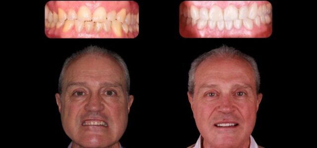 Aparece la foto de un paciente tras realizarse un tratamiento de carillas dentales estéticas