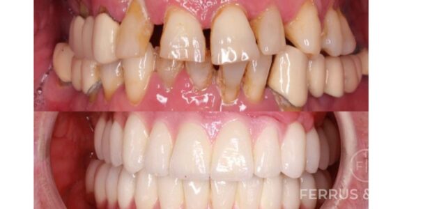 Fotos de antes y despues de piorrea