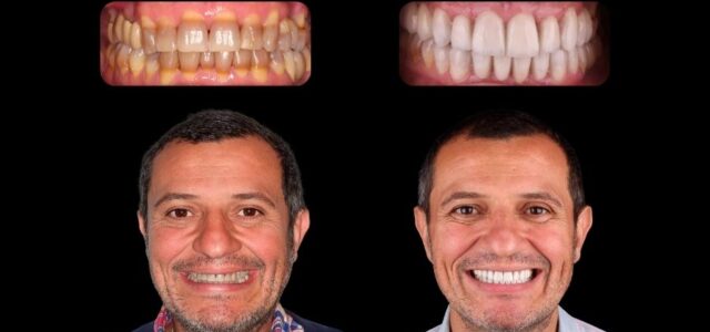 Foto de carillas dentales por caso de tetraciclinas