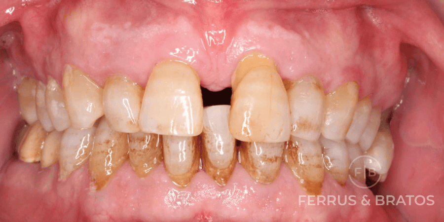 caso de piorrea moderada