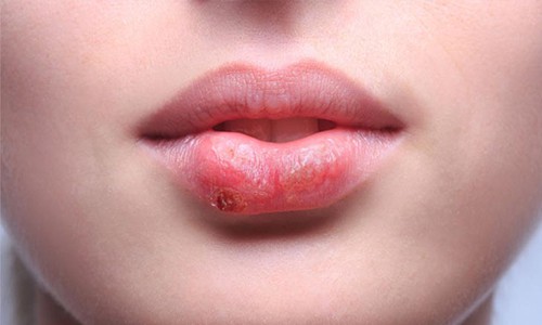 tratamiento casero para el herpes labial tratamiento casero para el herpes labial