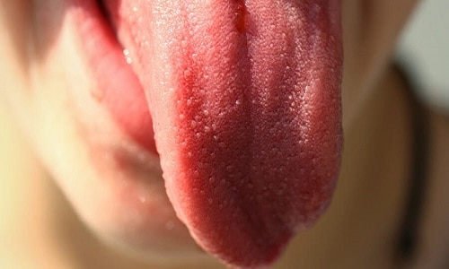 Protuberancias en la lengua Causas y tratamientos