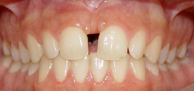 Diastema por frenillo