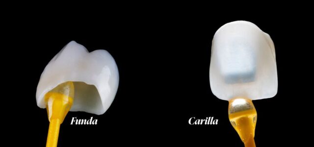 Elegir entre carillas dentales o fundas dependerá de tu estado de boca inicial
