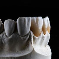 Opción de fundas o carillas dentales en la Clínica Dental Ferrus & Bratos