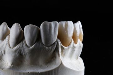 Opción de fundas o carillas dentales en la Clínica Dental Ferrus & Bratos