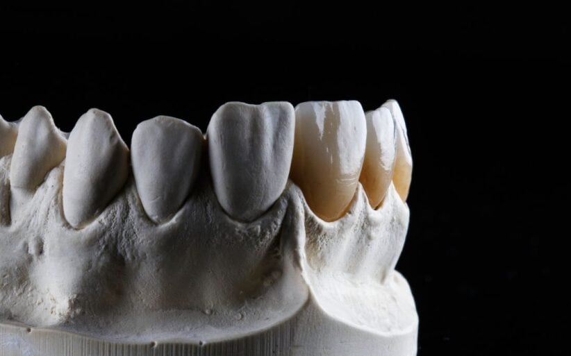 Opción de fundas o carillas dentales en la Clínica Dental Ferrus & Bratos