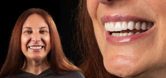 Aparece paciente después de su tratamiento de carillas dentales o fundas