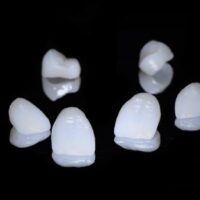Las diferencias clave entre carillas y fundas dentales