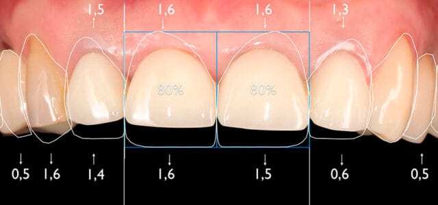 Contorneado dental