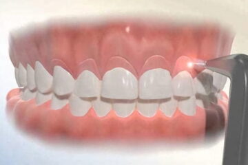 Cirugía periodontal: gingivectomía