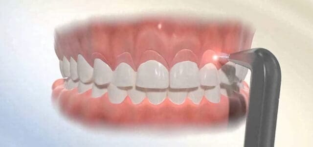 Gingivectomía estética Cirugía periodontal: gingivectomía