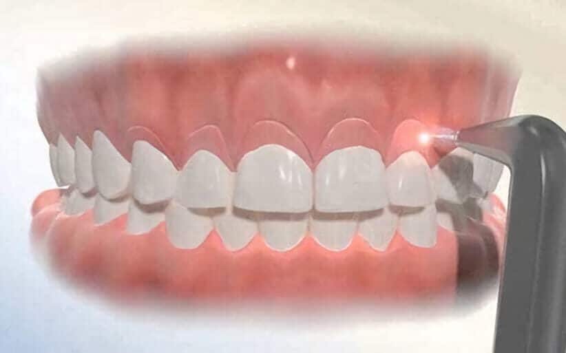 Gingivectomía estética Cirugía periodontal: gingivectomía