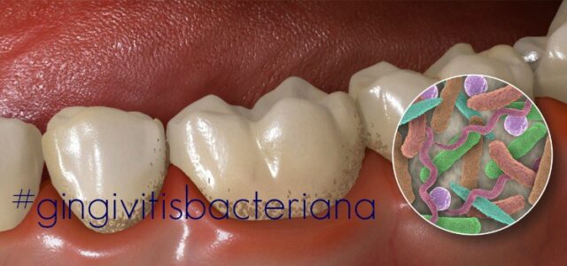 gingivitis bacterias como curar la gingivitis