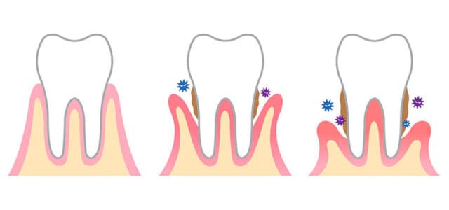 periodontitis crónica