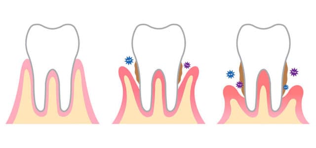 periodontitis crónica