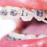 Gomas brackets