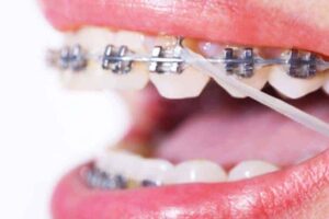 Gomas brackets