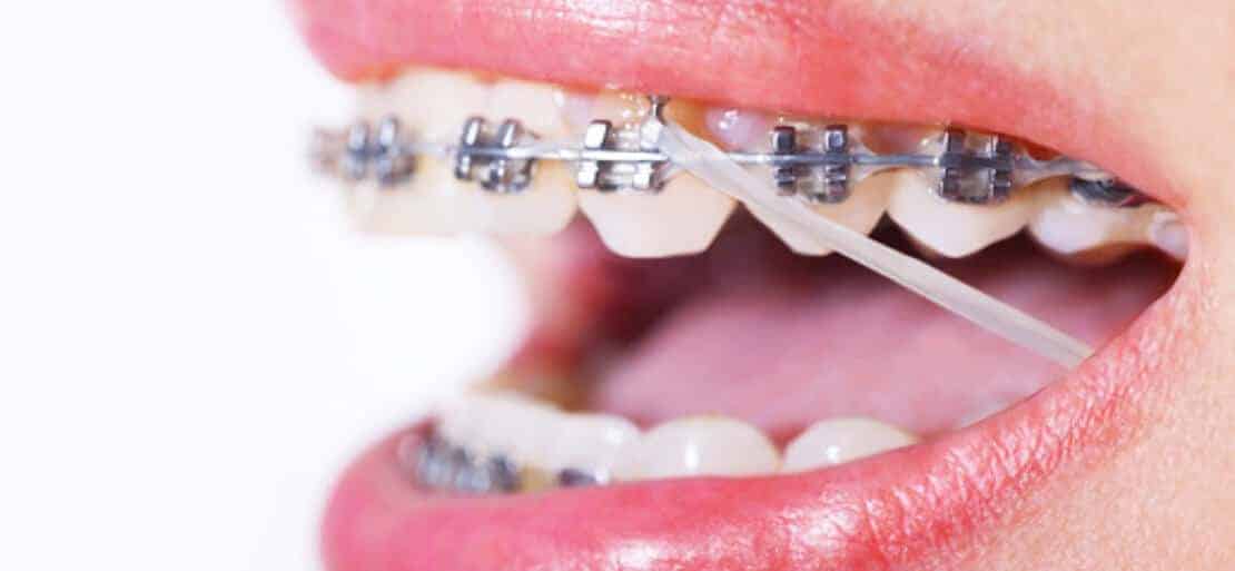 Gomas de brackets ¿Para qué sirven en ortodoncia?