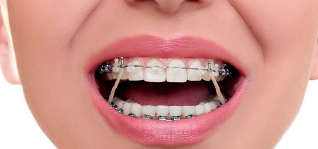 Tratamiento de ortodoncia con gomas