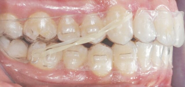 Gomas de ortodoncia en Invisalign