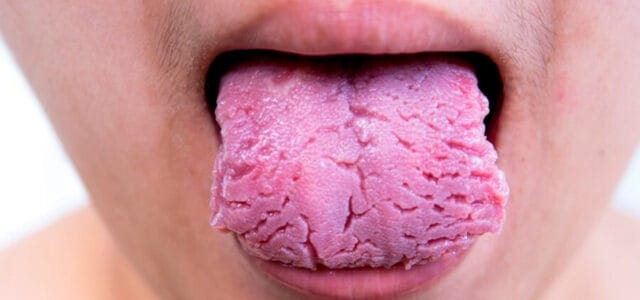 Quitar grietas en la lengua