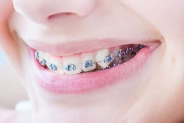 Hablar bien con brackets