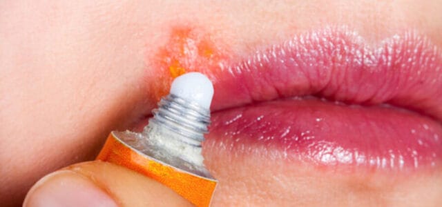 Tratamiento para herpes labial