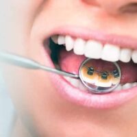 Brackets e higiene dental