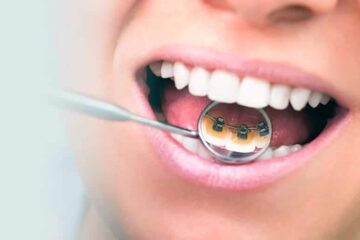 Brackets e higiene dental