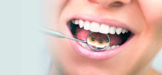 digerir ballet Todavía Cómo limpiar los dientes con brackets | Ferrus&Bratos