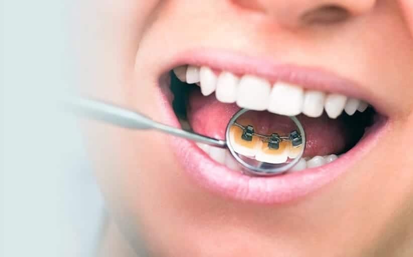 Brackets e higiene dental