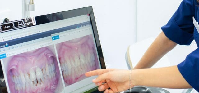 Boca con y sin placa dental