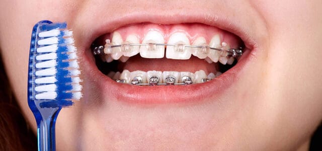 Cómo limpiar los brackets