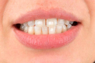 Hipocalcificación dental