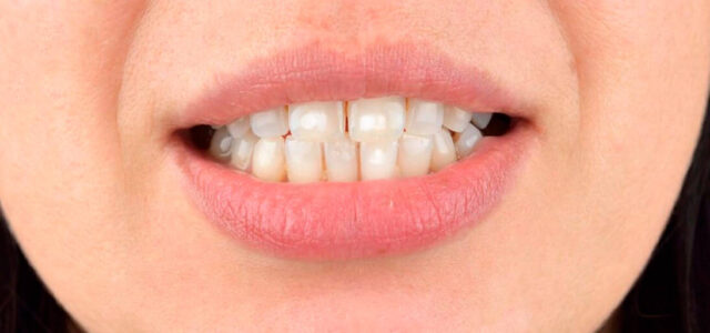 Hipocalcificación de un diente Hipocalcificación dental