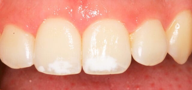 mancha blanca en los dientes