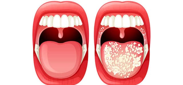 Resumen de 33+ artículos: como eliminar bacterias en la boca ...